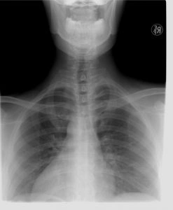 An x-ray of a person's neck area.